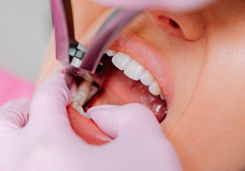 Extracciones dentales Gijón