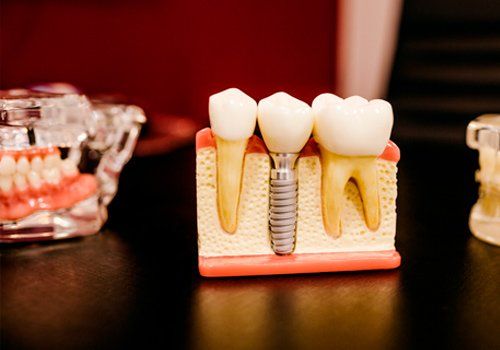 Implantes dentales en Gijón