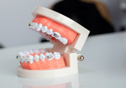 Ortodoncia en Gijón